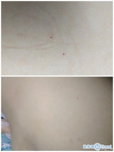 今日热点：喀布尔自杀式爆 炸 曝幼儿园针扎幼儿