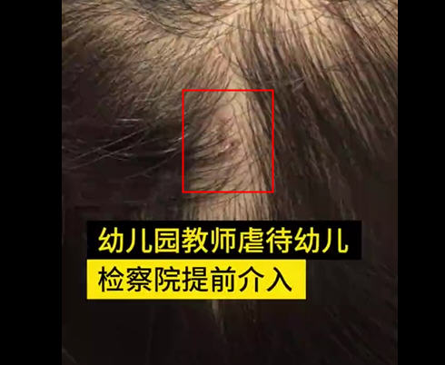 热点：检察院提前介入幼儿被针扎事件 景区回应要求残疾人展示残疾部位