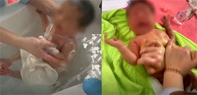 23天婴儿医院洗澡按摩后肠坏死