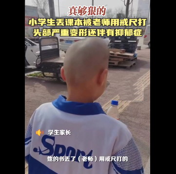 小学生丢课本被老师用戒尺打得头部变形