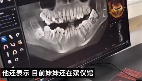 女子拔牙后坠亡事件后续