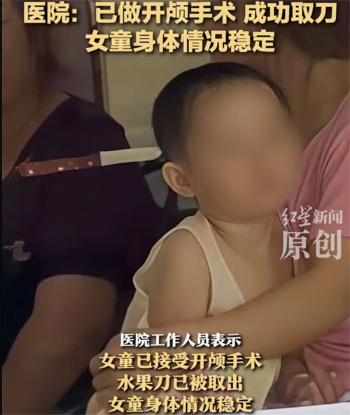 3岁女童头上插刀系妈妈不慎刺入