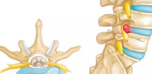 男子在家连拔2天火罐致高位截瘫