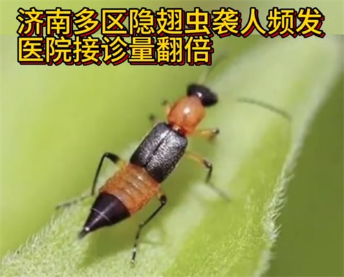 医院隐翅虫皮炎患者接诊量翻倍