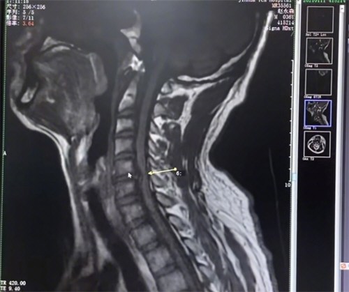 男子按摩要求大力后突发小脑梗死 男子按摩要求大力后突发小脑梗死