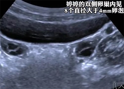 7岁女童3个月猛蹿4cm确诊性早熟