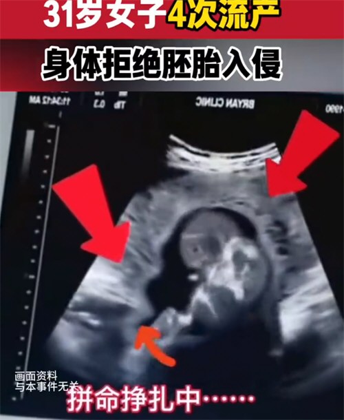 女子免疫系统攻击胚胎8年反复流产 女子免疫系统攻击胚胎8年反复流产