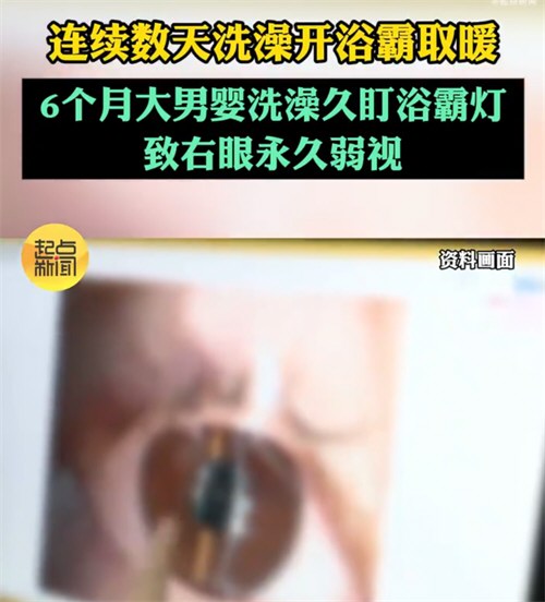 男婴洗澡久盯浴霸灯右眼永久弱视 男婴洗澡久盯浴霸灯右眼永久弱视