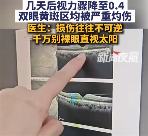 男子直视太阳10分钟视力降至0.4