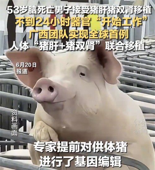 53岁脑死亡男子接受猪肝猪双肾移植