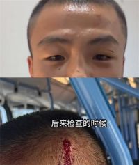 中国拳击手在澳公交上遭锥子扎头 拳击手在澳大利亚被揍差点丧命