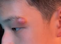 女明星为孩子挤痘致其脸缝四针 危险三角区外的痘痘也别乱挤