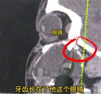 15岁男孩智齿长到眼窝里妈妈发声 医生回应男孩智齿长到眼窝里