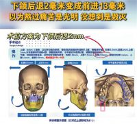 正颌手术做反了女孩说迎接她的是毁灭 女孩正颌手术后毁容